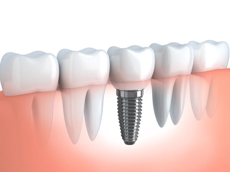 Dental Implants Saskatoon, SK SN A